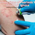 Learn the early warning signs of psoriasis that many people overlook. Spotting these symptoms early can help with timely treatment and better skin health.