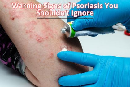 Learn the early warning signs of psoriasis that many people overlook. Spotting these symptoms early can help with timely treatment and better skin health.