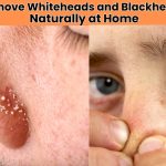 Want clear skin without harsh chemicals? Discover how to remove whiteheads and blackheads naturally using easy home remedies for a glowing, fresh face.