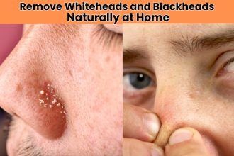 Want clear skin without harsh chemicals? Discover how to remove whiteheads and blackheads naturally using easy home remedies for a glowing, fresh face.