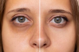 How to Reduce Dark Circles Naturally