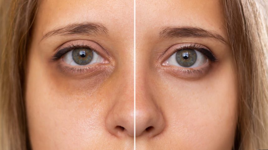 How to Reduce Dark Circles Naturally